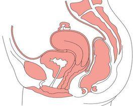 宮頸瀦留囊腫 宮頸瀦留囊腫
