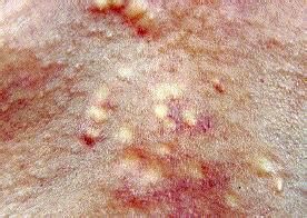 多發性脂囊瘤 多發性脂囊瘤