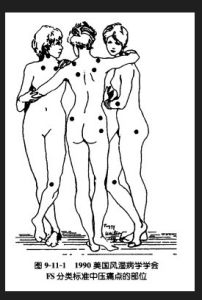 纖維肌痛綜合徵