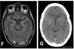 顱內低壓綜合徵