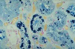 特發性肺含鐵血黃素沉著症 特發性肺含鐵血黃素沉著症