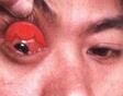結膜結核病 結膜結核病
