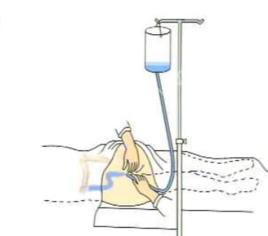 灌腸療法 灌腸療法
