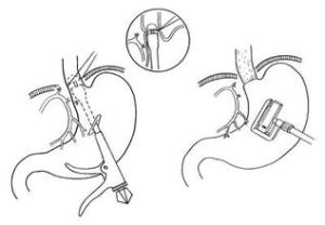 消化道吻合器 消化道吻合器