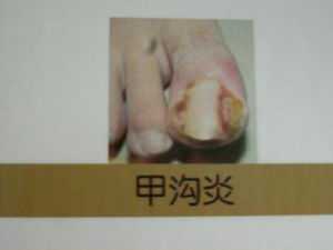 真菌性甲溝炎 真菌性甲溝炎