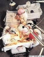 針刺麻醉 針刺麻醉