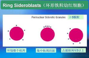 環形鐵粒幼紅細胞 環形鐵粒幼紅細胞