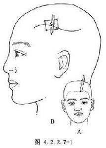 顱內插入異物摘除術 顱內插入異物摘除術