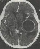 新生兒化膿性腦膜炎 新生兒化膿性腦膜炎