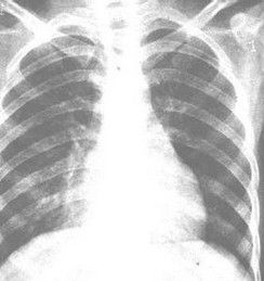 肺炎克雷伯菌 肺炎克雷伯菌