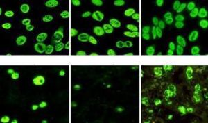 抗中性粒細胞胞漿抗體 抗中性粒細胞胞漿抗體