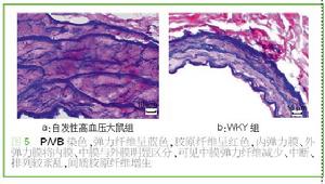鹽敏感性高血壓