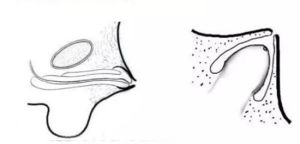 隱匿型陰莖 隱匿型陰莖