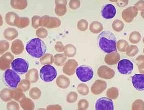 急性淋巴細胞白血病