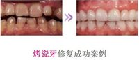 烤瓷牙修復成功案例