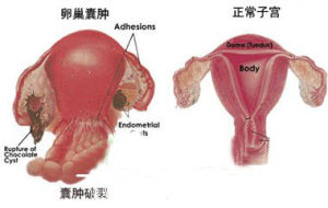 子宮附屬檔案囊腫