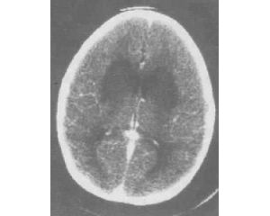 小兒病毒性腦炎