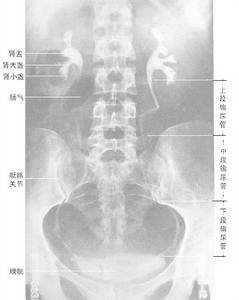 非甾體類抗炎藥物性腎病