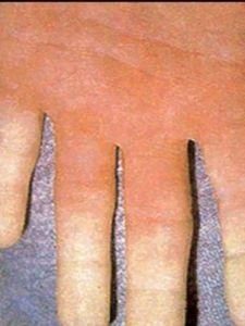 雷諾現象 雷諾現象