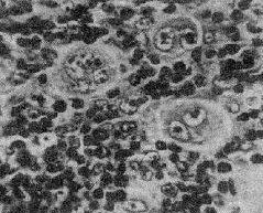 小兒縱隔囊腫及腫瘤 小兒縱隔囊腫及腫瘤