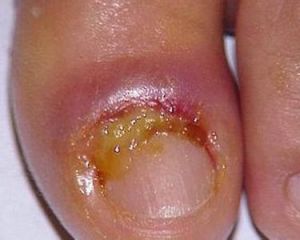 化膿性指頭炎 化膿性指頭炎