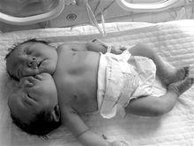 新生雙頭嬰兒