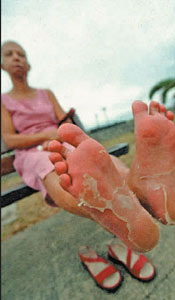 感染“基孔肯雅”病毒的留尼旺島居民出現嚴重蛻皮症狀