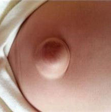 小兒臍疝 小兒臍疝