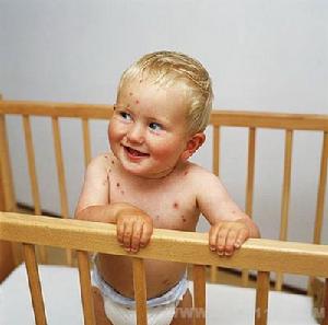 新生兒柯薩奇病毒B感染