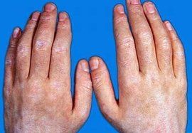 色素減退斑 色素減退斑