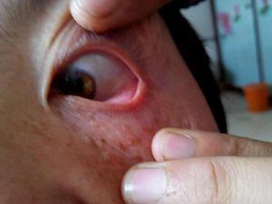 眼珠胬肉攀睛 眼珠胬肉攀睛