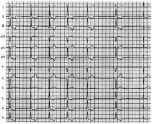 加速性心律 加速性心律