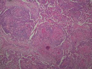 小兒結節病 小兒結節病