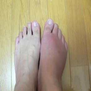 第一跖趾關節 第一跖趾關節