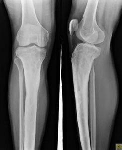 急性骨髓炎 急性骨髓炎