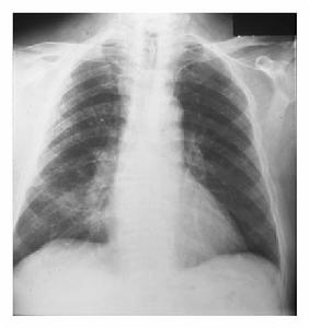 非特異性間質性肺炎