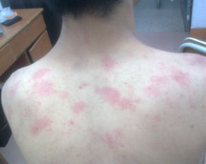 冬季皮炎 冬季皮炎