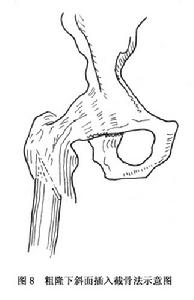 （圖）髖關節結核病