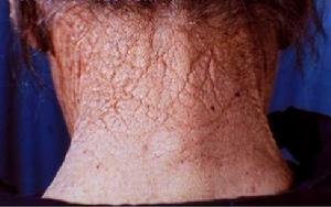 項部菱形皮膚 項部菱形皮膚