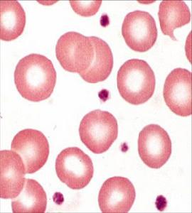 新生兒失血性貧血