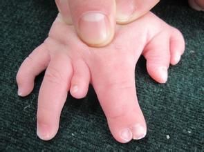 多指畸形
