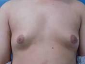 男子乳房發育症 男子乳房發育症