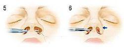 一種鼻部手術過程