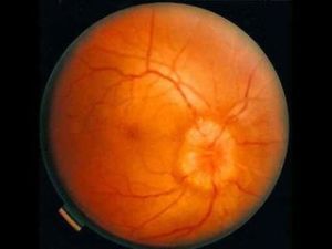 腦膜炎球菌性腦膜炎