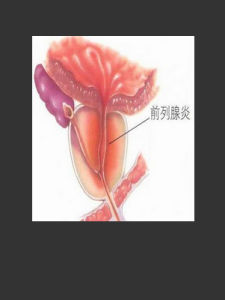 無菌性前列腺炎 無菌性前列腺炎