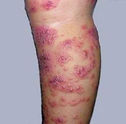 帶狀皰疹後遺神經痛