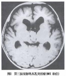 脈絡叢乳頭狀瘤