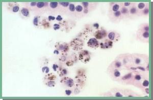 Burkitt淋巴瘤 Burkitt淋巴瘤