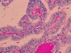 甲狀腺乳頭狀癌 甲狀腺乳頭狀癌