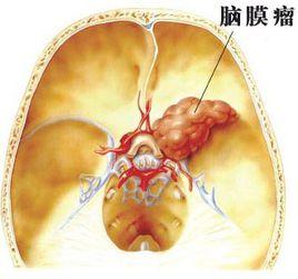 良性腦瘤 良性腦瘤